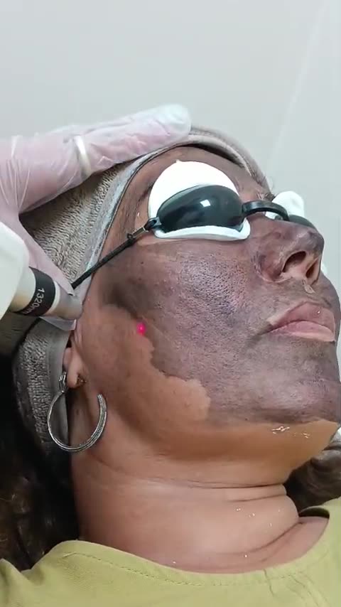 Lazer cilt uygulaması videosu